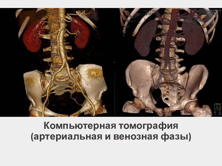 Компьютерная томография (артериальная и венозная фазы)