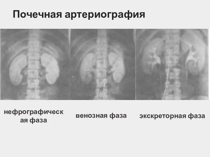 Почечная артериография нефрографическая фаза венозная фаза экскреторная фаза