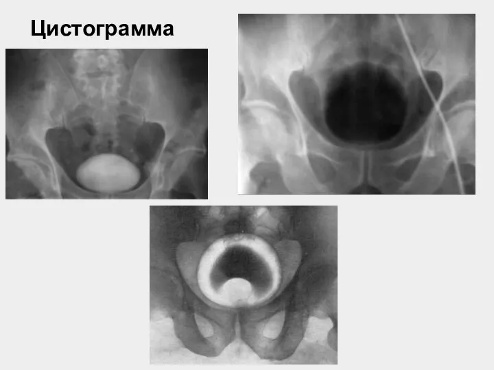 Цистограмма