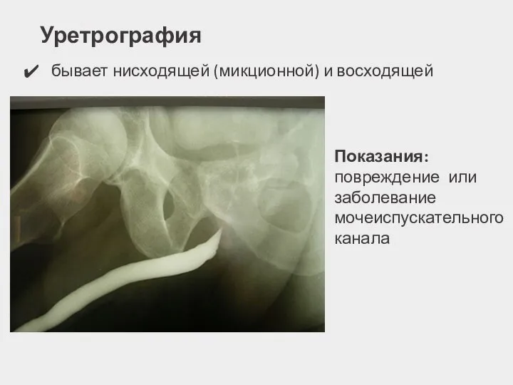 Уретрография бывает нисходящей (микционной) и восходящей Показания: повреждение или заболевание мочеиспускательного канала