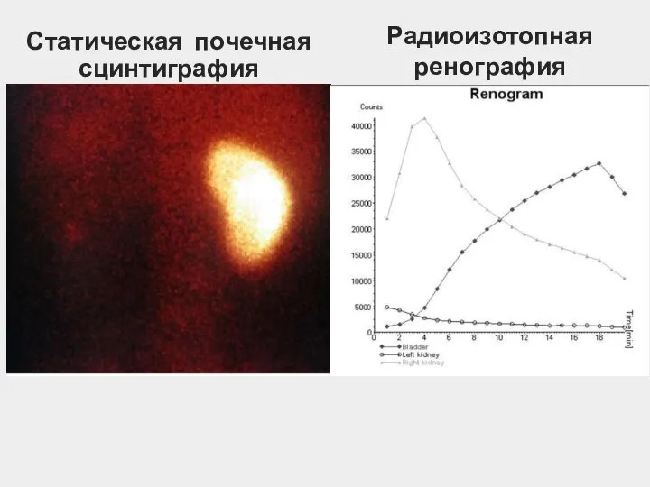 Статическая почечная сцинтиграфия Радиоизотопная ренография