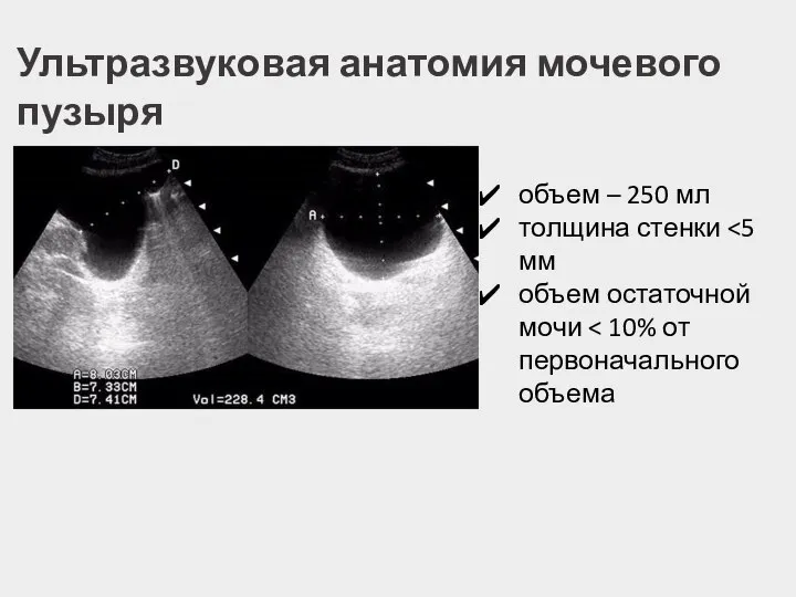 Ультразвуковая анатомия мочевого пузыря объем – 250 мл толщина стенки объем остаточной мочи