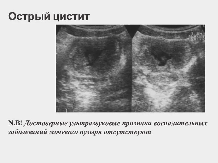 Острый цистит N.B! Достоверные ультразвуковые признаки воспалительных заболеваний мочевого пузыря отсутствуют