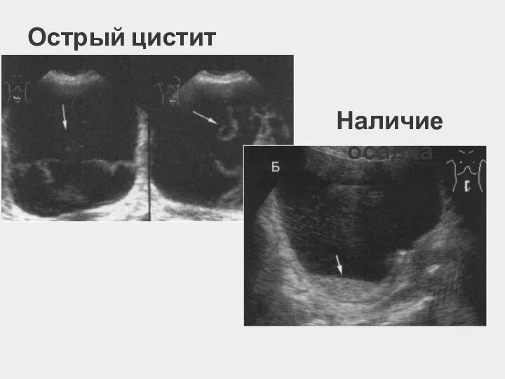 Острый цистит Наличие осадка