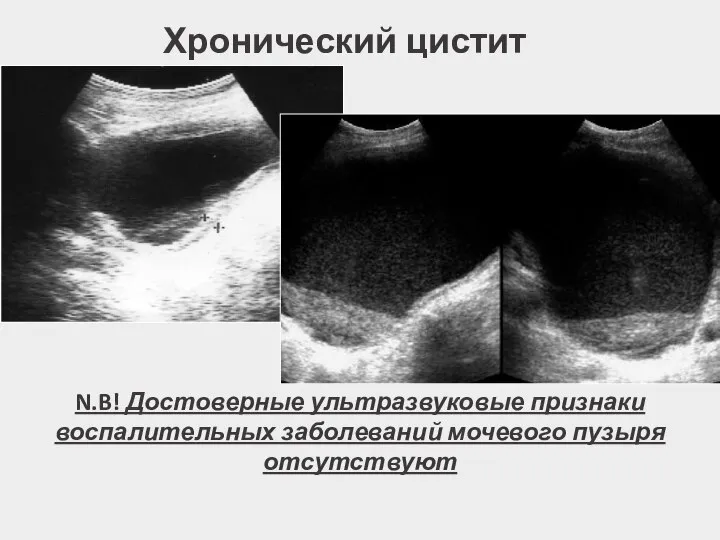 Хронический цистит N.B! Достоверные ультразвуковые признаки воспалительных заболеваний мочевого пузыря отсутствуют