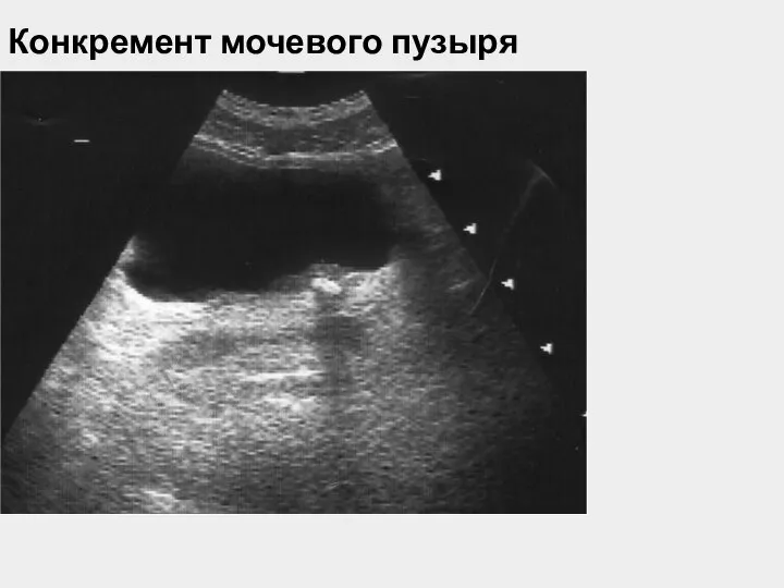 Конкремент мочевого пузыря