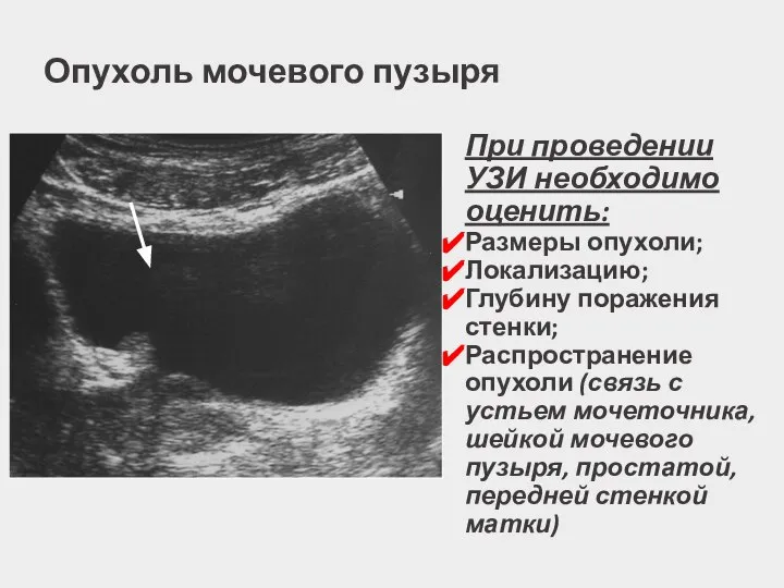 При проведении УЗИ необходимо оценить: Размеры опухоли; Локализацию; Глубину поражения стенки; Распространение