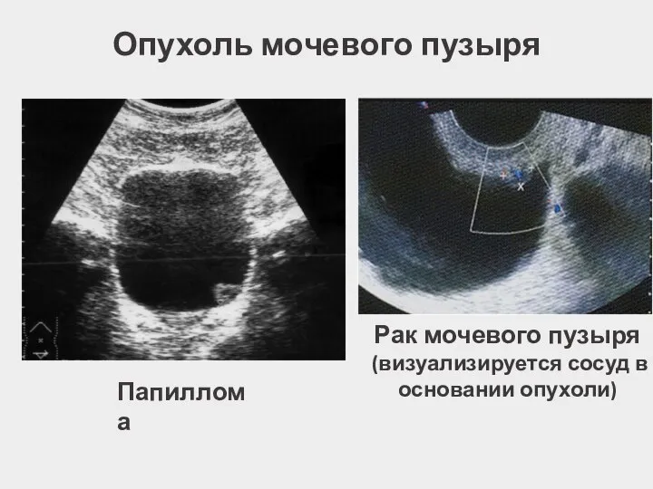 Опухоль мочевого пузыря Папиллома Рак мочевого пузыря (визуализируется сосуд в основании опухоли)