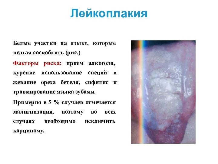 Лейкоплакия Белые участки на языке, которые нельзя соскоблить (рис.) Факторы риска: прием