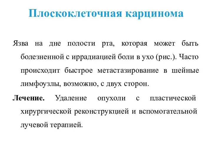 Плоскоклеточная карцинома Язва на дне полости рта, которая может быть болезненной с