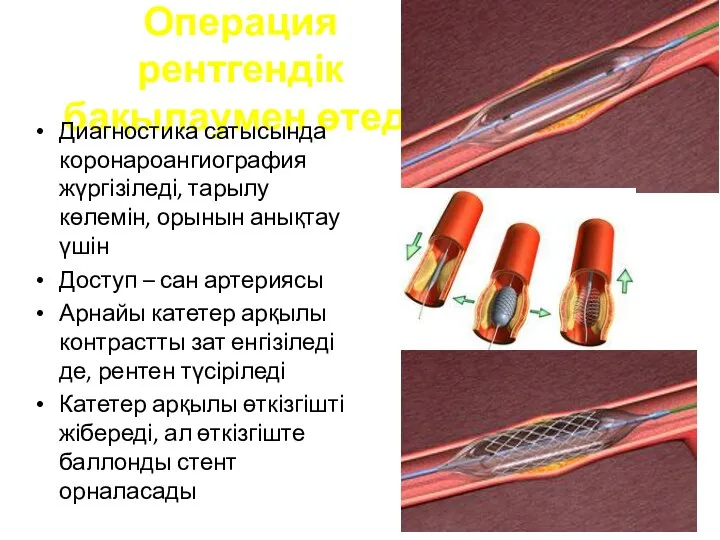 Операция рентгендік бақылаумен өтеді Диагностика сатысында коронароангиография жүргізіледі, тарылу көлемін, орынын анықтау