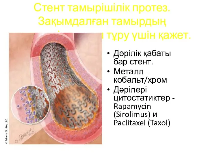 Стент тамырішілік протез. Зақымдалған тамырдың диаметрін сақтап тұру үшін қажет. Дәрілік қабаты