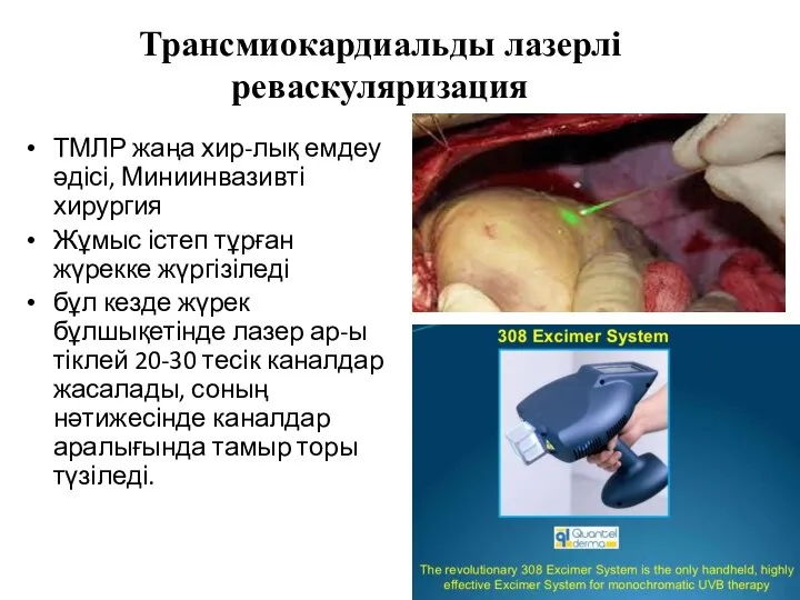 Трансмиокардиальды лазерлі реваскуляризация ТМЛР жаңа хир-лық емдеу әдісі, Миниинвазивті хирургия Жұмыс істеп