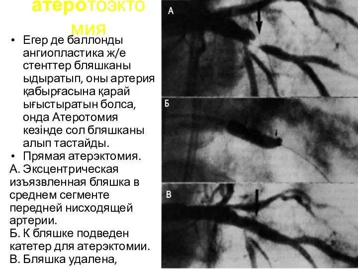 атеротоэктомия Егер де баллонды ангиопластика ж/е стенттер бляшканы ыдыратып, оны артерия қабырғасына