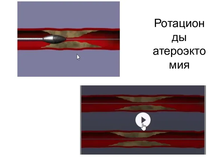 Ротационды атероэктомия