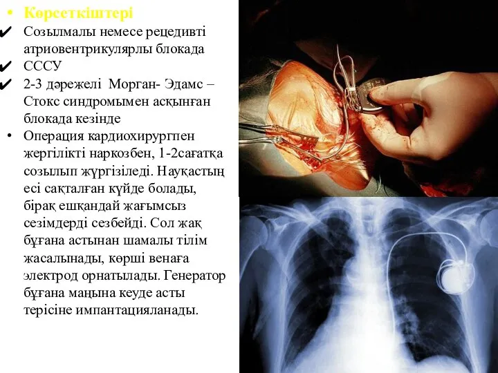 Көрсеткіштері Созылмалы немесе рецедивті атриовентрикулярлы блокада СССУ 2-3 дәрежелі Морган- Эдамс –Стокс