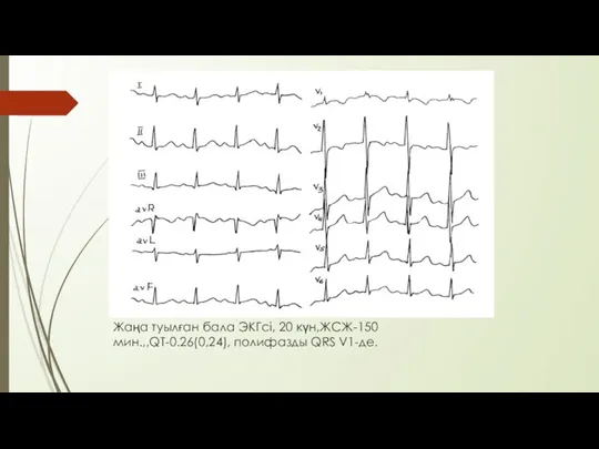 Жаңа туылған бала ЭКГсі, 20 күн,ЖСЖ-150 мин.,,QT-0.26(0,24), полифазды QRS V1-де.