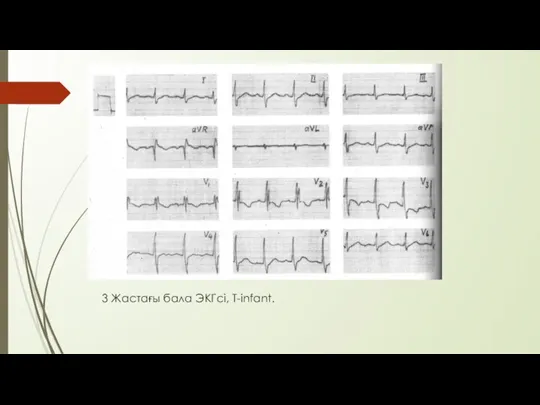 3 Жастағы бала ЭКГсі, Т-infant.
