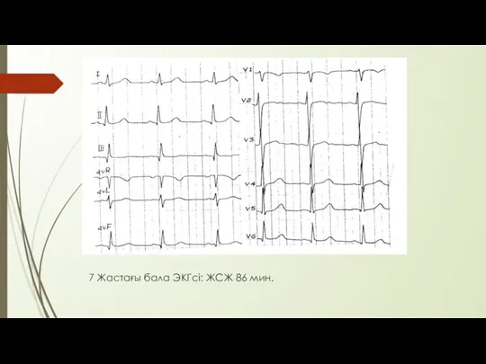 7 Жастағы бала ЭКГсі: ЖСЖ 86 мин.
