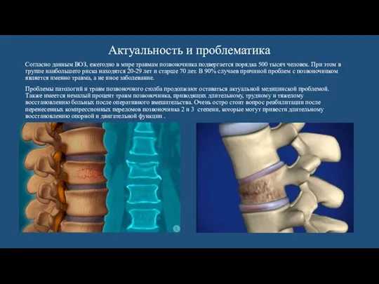 Актуальность и проблематика Согласно данным ВОЗ, ежегодно в мире травмам позвоночника подвергается