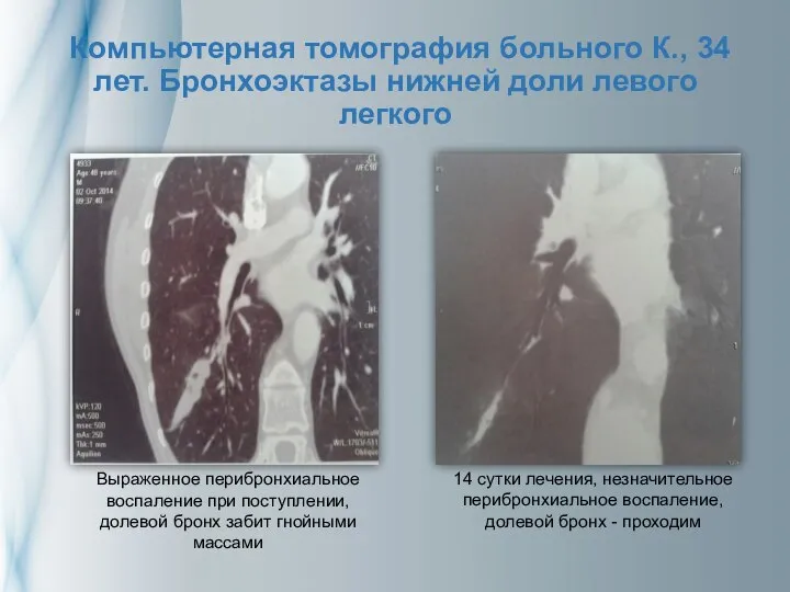 Компьютерная томография больного К., 34 лет. Бронхоэктазы нижней доли левого легкого Выраженное