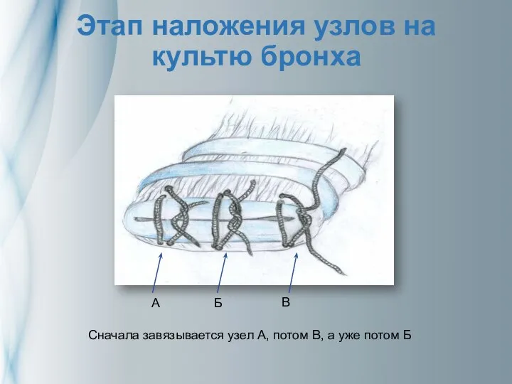 Этап наложения узлов на культю бронха Сначала завязывается узел А, потом В,