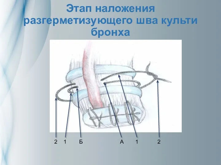 Этап наложения разгерметизующего шва культи бронха 2 1 Б А 1 2