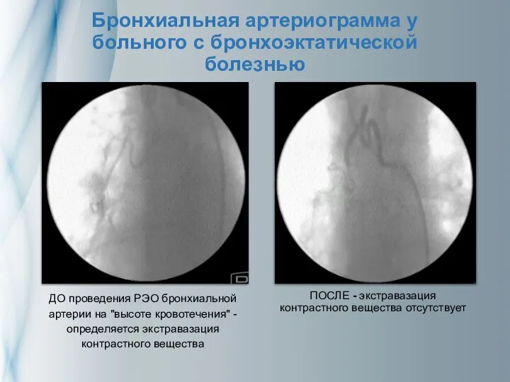 Бронхиальная артериограмма у больного с бронхоэктатической болезнью ДО проведения РЭО бронхиальной артерии