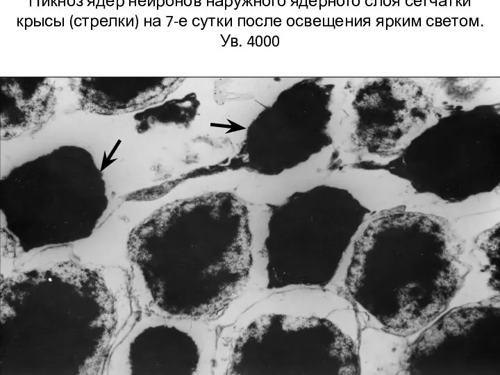 Пикноз ядер нейронов наружного ядерного слоя сетчатки крысы (стрелки) на 7-е сутки