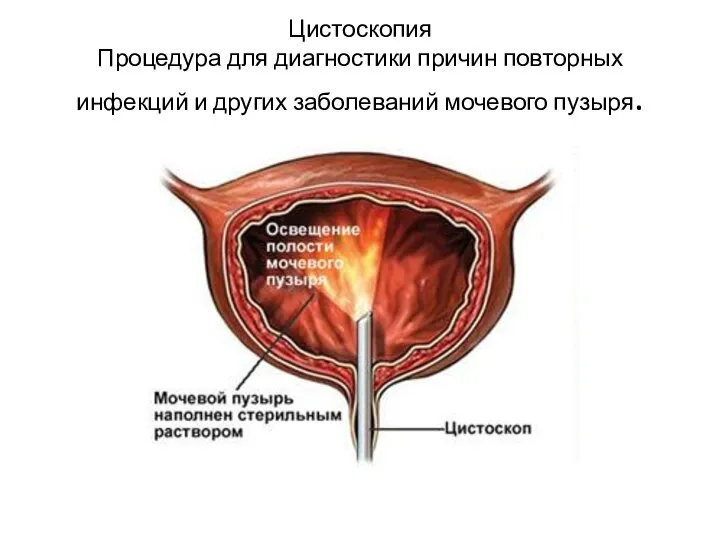 Цистоскопия Процедура для диагностики причин повторных инфекций и других заболеваний мочевого пузыря.