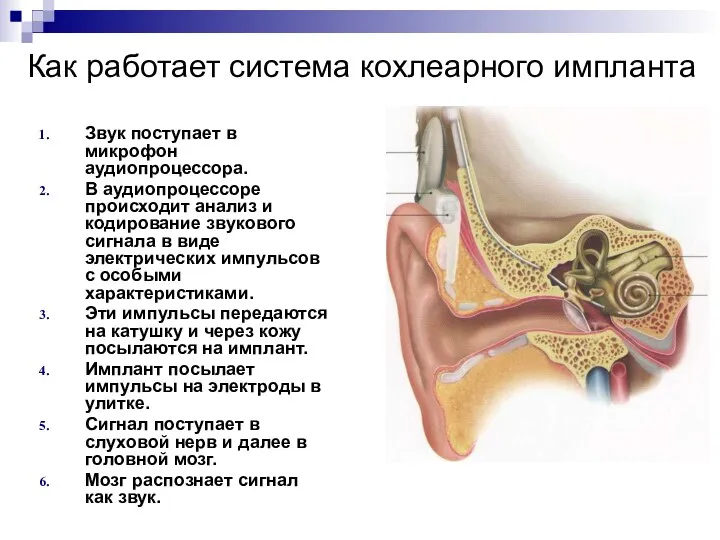 Как работает система кохлеарного импланта Звук поступает в микрофон аудиопроцессора. В аудиопроцессоре