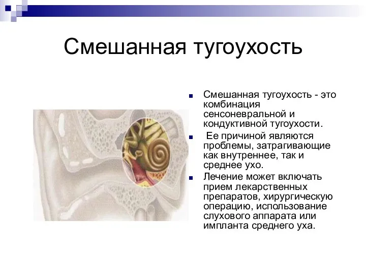 Смешанная тугоухость Смешанная тугоухость - это комбинация сенсоневральной и кондуктивной тугоухости. Ее