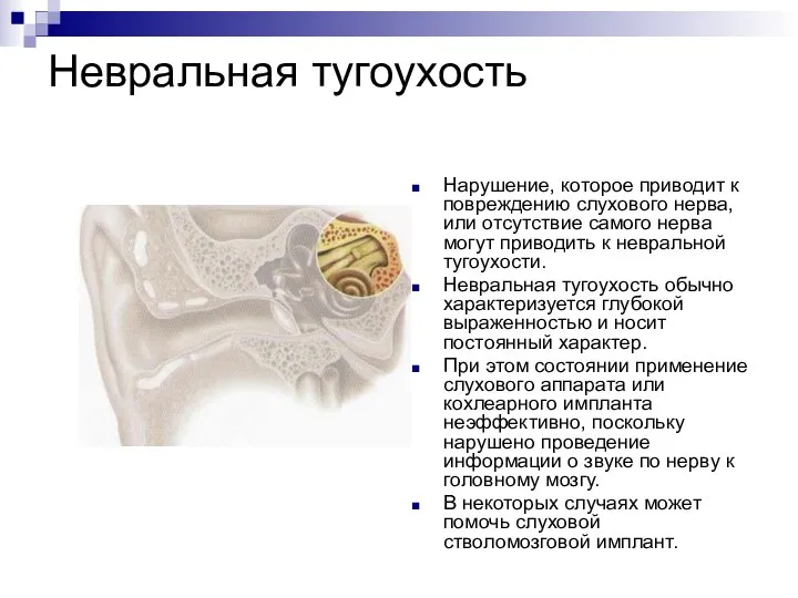 Невральная тугоухость Нарушение, которое приводит к повреждению слухового нерва, или отсутствие самого