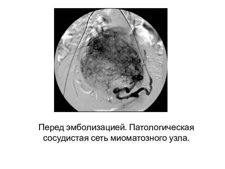 Перед эмболизацией. Патологическая сосудистая сеть миоматозного узла.