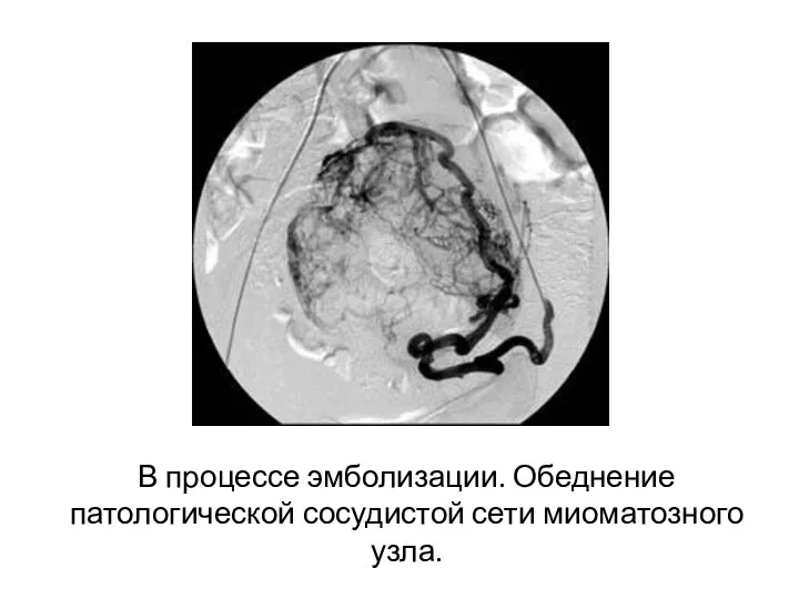 В процессе эмболизации. Обеднение патологической сосудистой сети миоматозного узла.