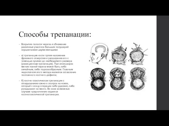 Способы трепанации: Вскрытие полости черепа и обнажение различных участков больших полушарий осуществляют