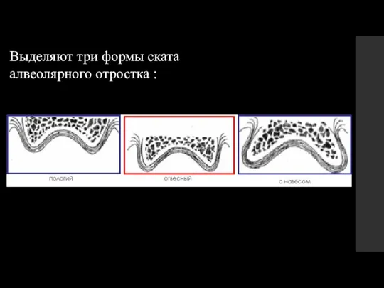 Выделяют три формы ската алвеолярного отростка :