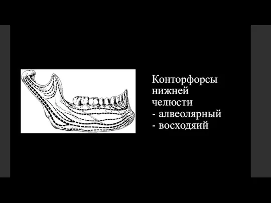 Конторфорсы нижней челюсти - алвеолярный - восходяий