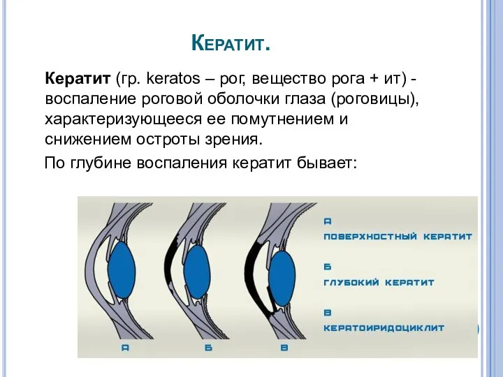 Кератит. Кератит (гр. keratos – рог, вещество рога + ит) - воспаление