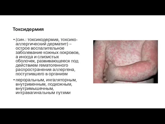 Токсидермия (син.: токсикодермия, токсико-аллергический дерматит) – острое воспалительное заболевание кожных покровов, а