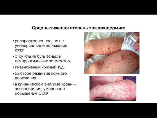 Средне-тяжелая степень токсикодермии: распространенное, но не универсальное поражение кожи отсутствие буллезных и