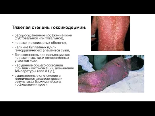 Тяжелая степень токсикодермии: распространенное поражение кожи (субтотальное или тотальное), поражение слизистых оболочек,