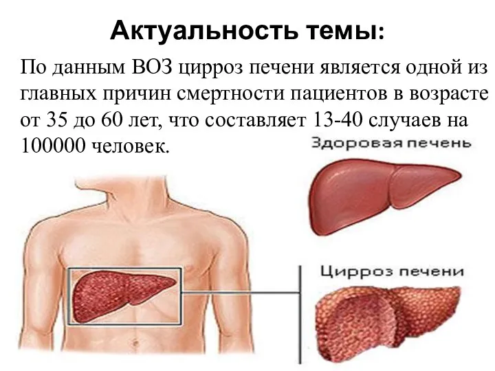 Актуальность темы: По данным ВОЗ цирроз печени является одной из главных причин