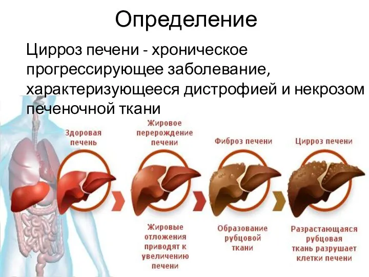 Цирроз печени - хроническое прогрессирующее заболевание, характеризующееся дистрофией и некрозом печеночной ткани Определение