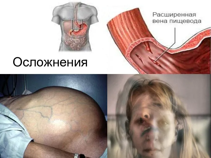 Осложнения