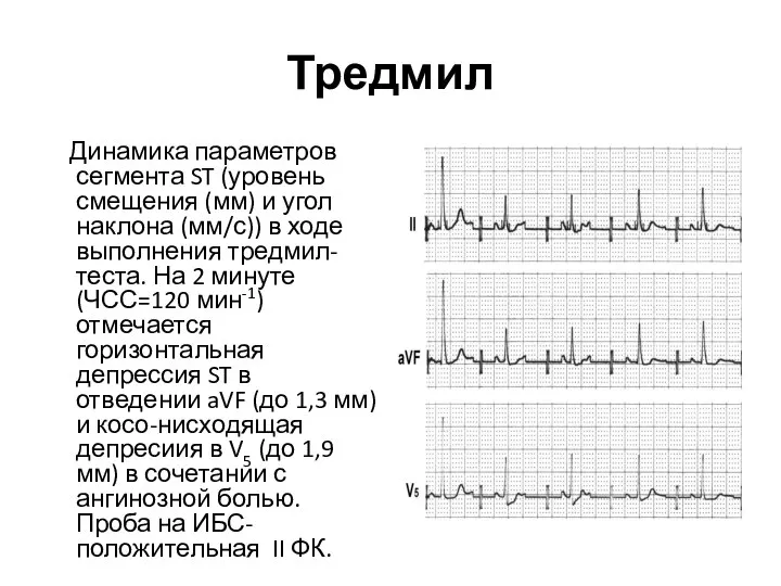 Тредмил Динамика параметров сегмента ST (уровень смещения (мм) и угол наклона (мм/с))