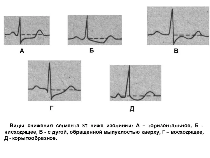Виды снижения сегмента ST ниже изолинии: А – горизонтальное, Б - нисходящее,