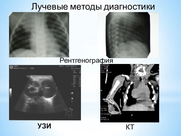 УЗИ Лучевые методы диагностики Рентгенография КТ