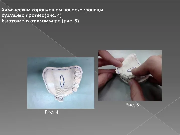 Химическим карандашем наносят границы будущего протеза(рис. 4) Изготовленяют кламмера (рис. 5) Рис. 4 Рис. 5