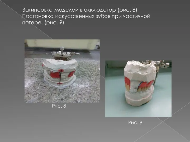 Загипсовка моделей в окклюдатор (рис. 8) Постановка искусственных зубов при частичной потере.